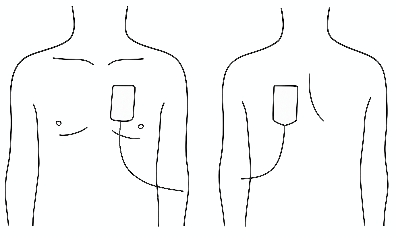 Position des électrodes de défibrillation