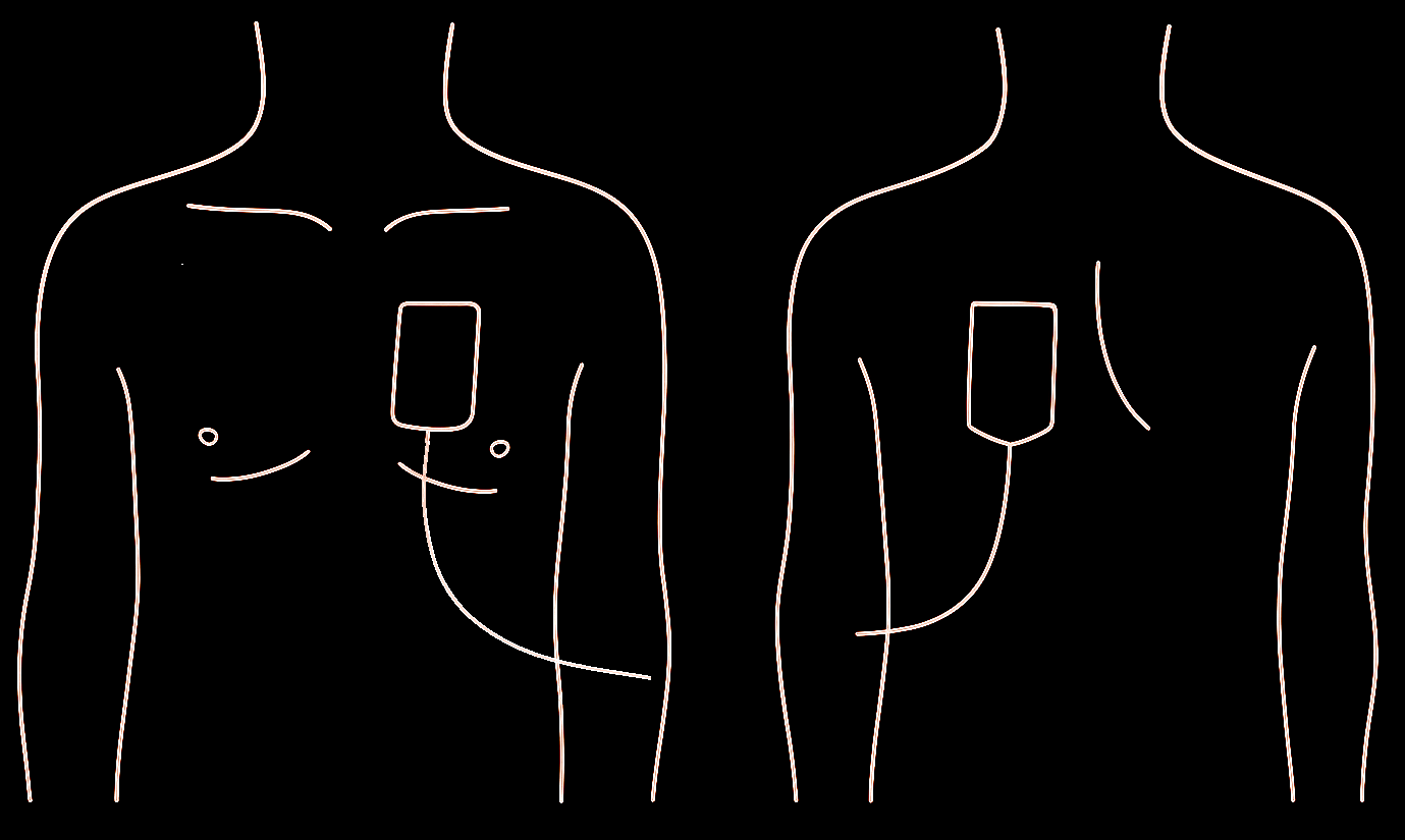 Position des électrodes de défibrillation