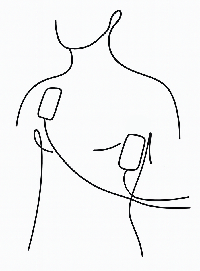 Position des électrodes de défibrillation
